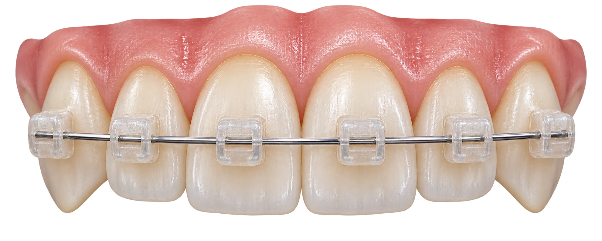 Render 3D del detalle de brackets estéticos sobre dientes anteriores