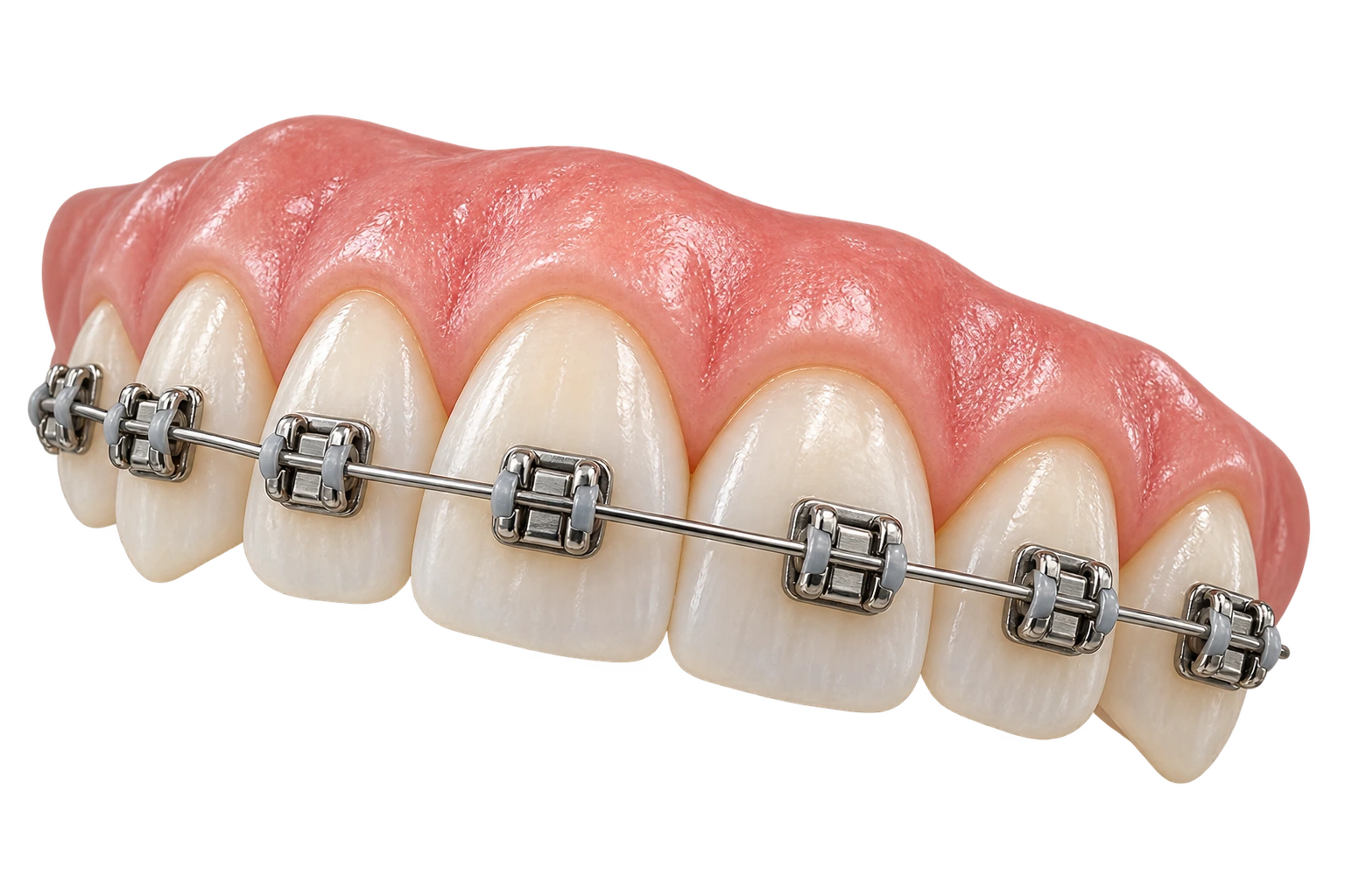 Render 3D de una arcada dental con brackets metálicos