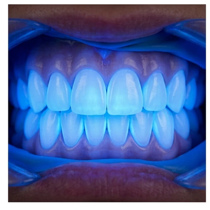 Visualización referencial de una sesión profesional de blanqueamiento dental